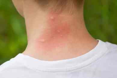 allergic-to-mosquito-bites
